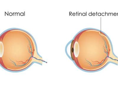 چیزهای ضروری که باید در خصوص بیماری جداشدگی شبکیه چشم بدانید چیزهای ضروری که باید در خصوص بیماری جداشدگی شبکیه چشم بدانید
