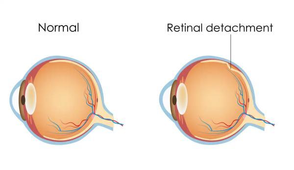 چیزهای ضروری که باید در خصوص بیماری جداشدگی شبکیه چشم بدانید
